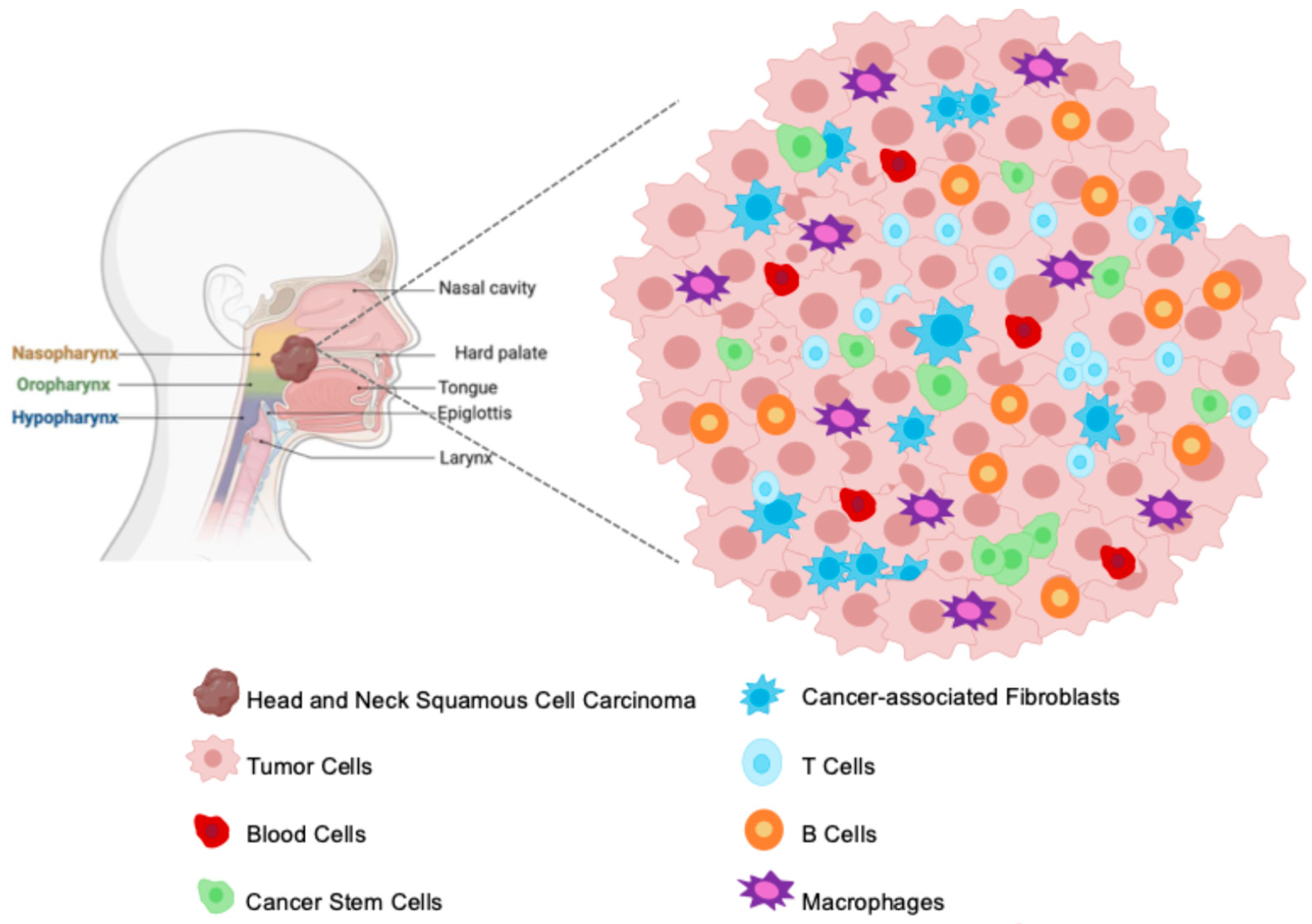 Figure 1: Spatial architecture of the HNSCC TME. This schematic provides a conceptual overview of the HNSCC TME and illustrates the spatial localization and interactions of key cellular components. The left panel shows the common anatomical sites where HNSCC tumors typically arise in the human head and neck region (e.g., nasopharynx, oropharynx, hypopharynx, tongue, larynx), with the dark brown mass representing a macroscopic HNSCC tumor. The right panel provides a conceptual schematic of the HNSCC TME at a microscopic level, showcasing the diverse cellular components that interact within this complex ecosystem. It depicts Tumor Cells (pink, spiky outline) as the predominant malignant population, intermingled with other critical cell types including Cancer Stem Cells (green), Blood Cells (red), Cancer-associated Fibroblasts (light blue stars), T Cells (light blue circles), B Cells (orange circles), and Macrophages (purple stars). This schematic emphasizes cellular diversity and the mixed distribution of components within the HNSCC TME.