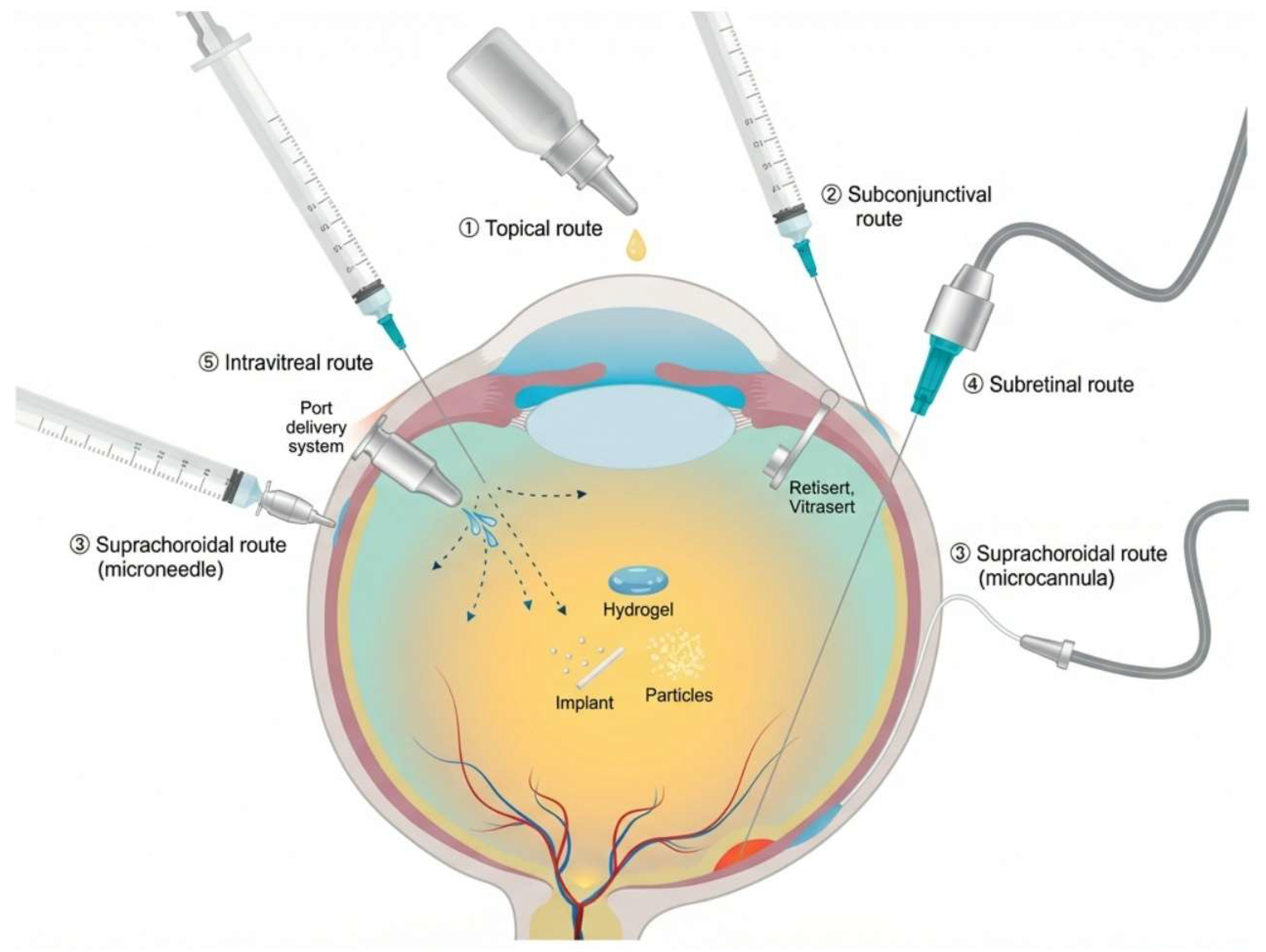 Figure 1: Examples of the commonly exploited administration routes for ocular drug delivery: (1) topical, (2) subconjunctival, (3) suprachoroidal, (4) subretinal, and (5) intravitreal injection and port delivery system. Reproduced from [3] (under the license of CC BY 4.0).