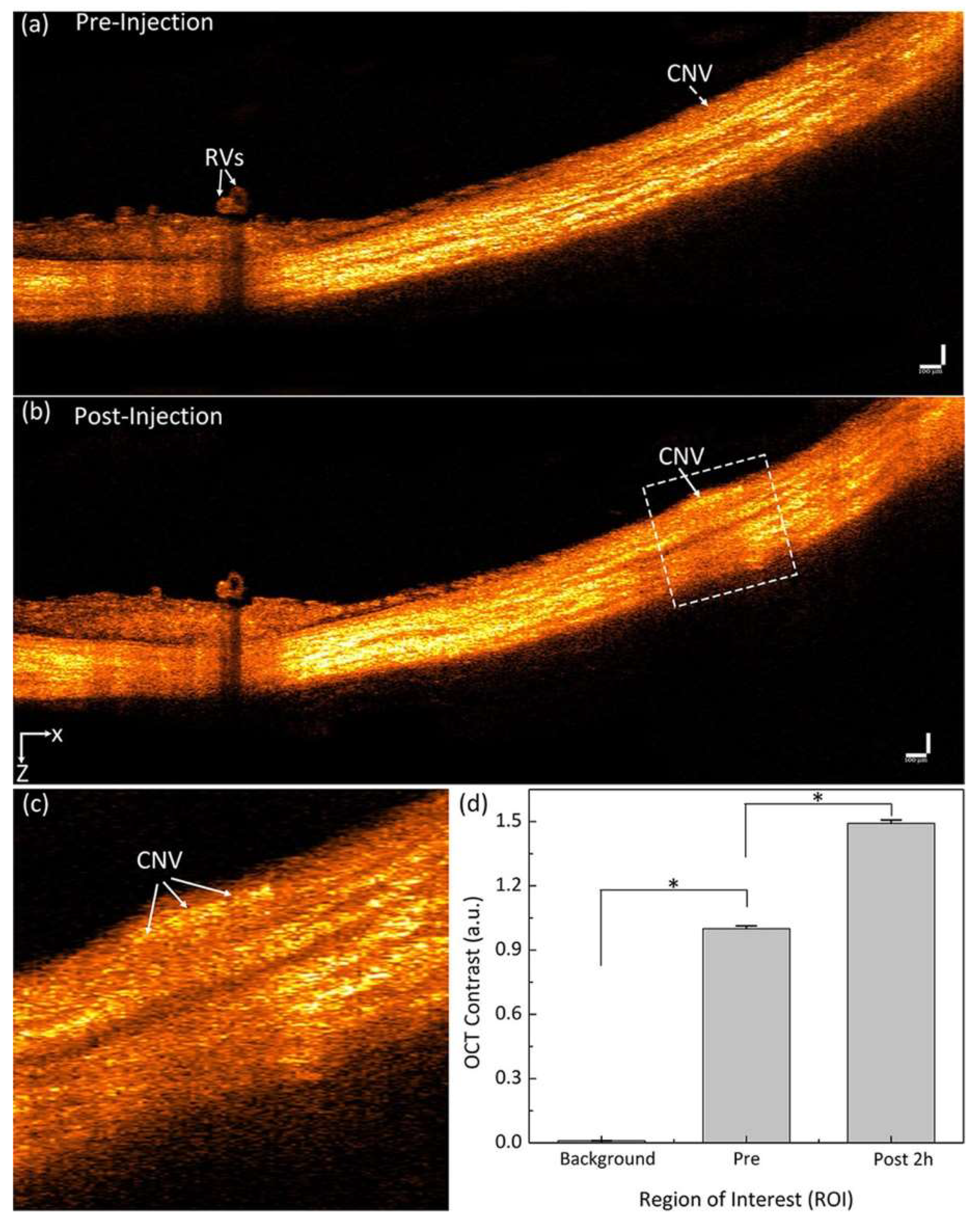 Figure 8: Enhanced in vivo OCT imaging contrast using gold nanostars: (a,b) B-scan OCT images before and two h after intravenous gold nanostars injection. White arrows indicate CNV position. (c) Magnified view of the area outlined in (b). (d) Spectral analysis of OCT intensity within the CNV before and two h after gold nanostars administration. Reproduced with permission from Ref. [69] (© [American Chemical Society]. Permission obtained via Copyright Clearance Center (CCC) RightsLink).