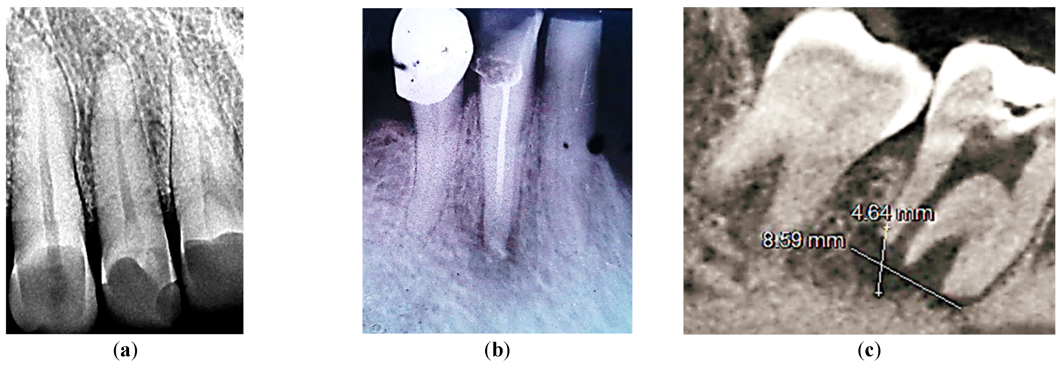 Figure 1: Radiograph of tooth 12 without signs of resorption (a). Radiograph of tooth 42 with signs of moderate resorption (b). CBCT section of tooth 47 with signs of severe resorption (c).