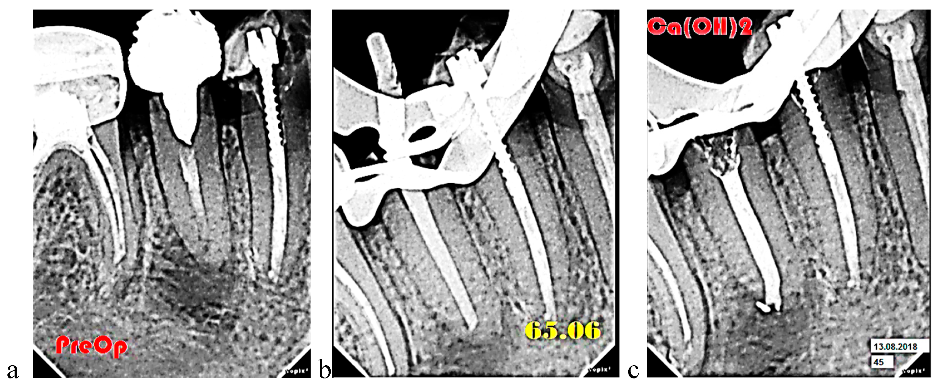 Figure 2: Example of determining the apical stop with a calibrated gutta-percha pin. Radiographs of tooth 45: initial situation (a); image with a calibrated gutta-percha pin of 06 taper (b); image with a temporary calcium-containing material in the root canal (c).