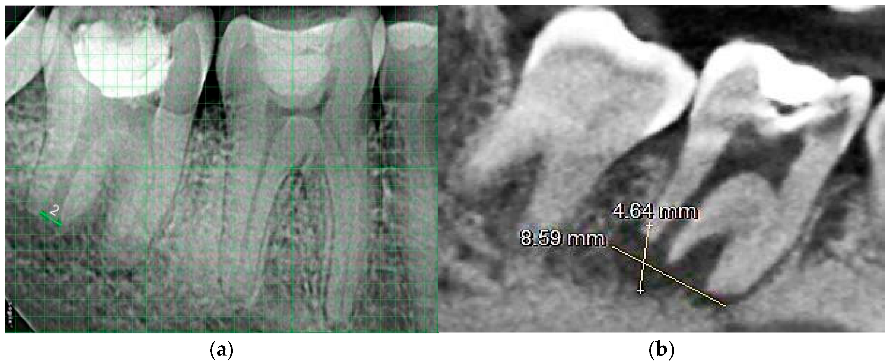 Figure 1: (a) Radiovisiographic image of tooth 47 (b) CBCT section of tooth 47.
