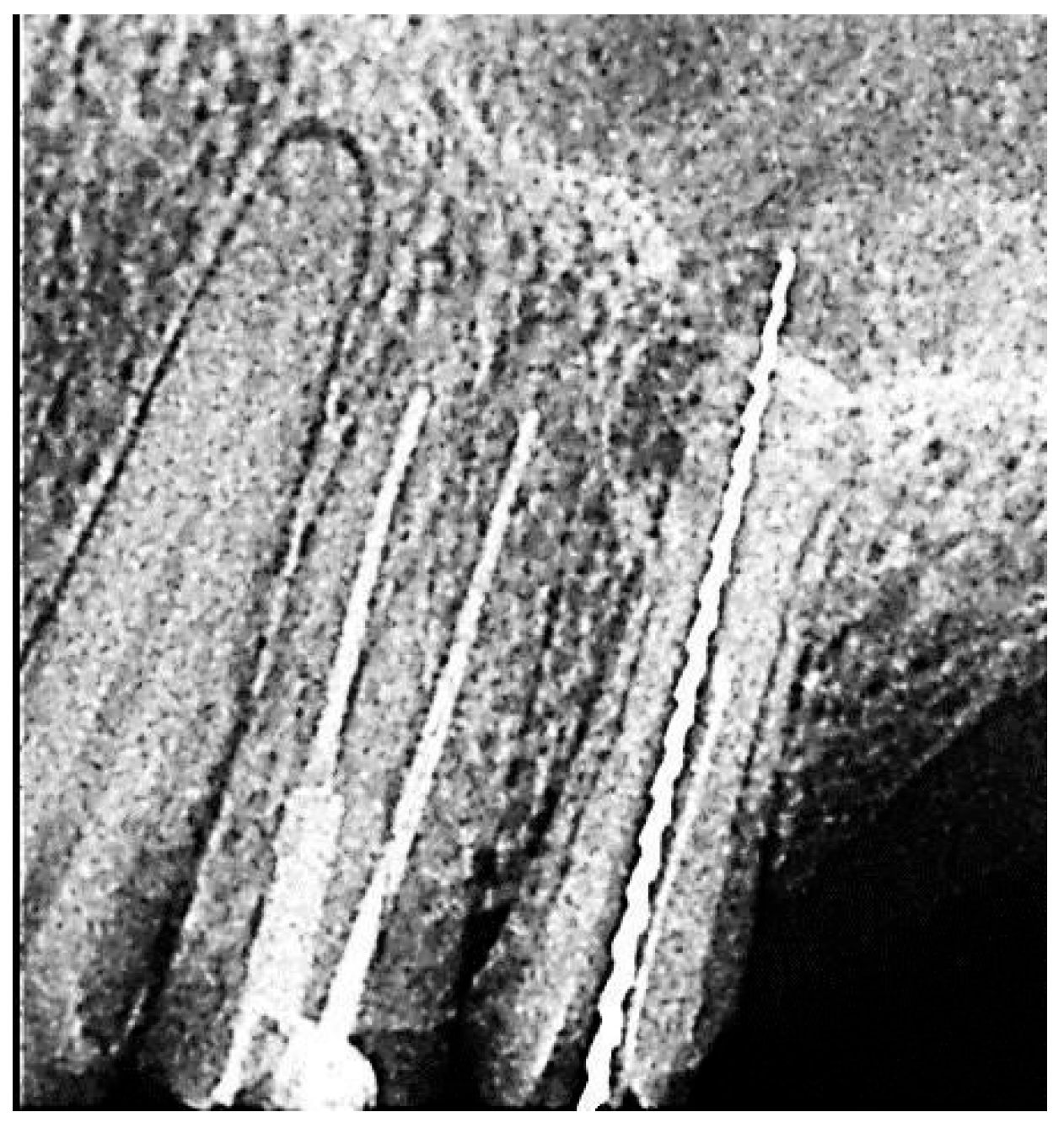 Figure 2: X-ray of tooth #25 with a 35.02 K-reamer inserted into the root canal.