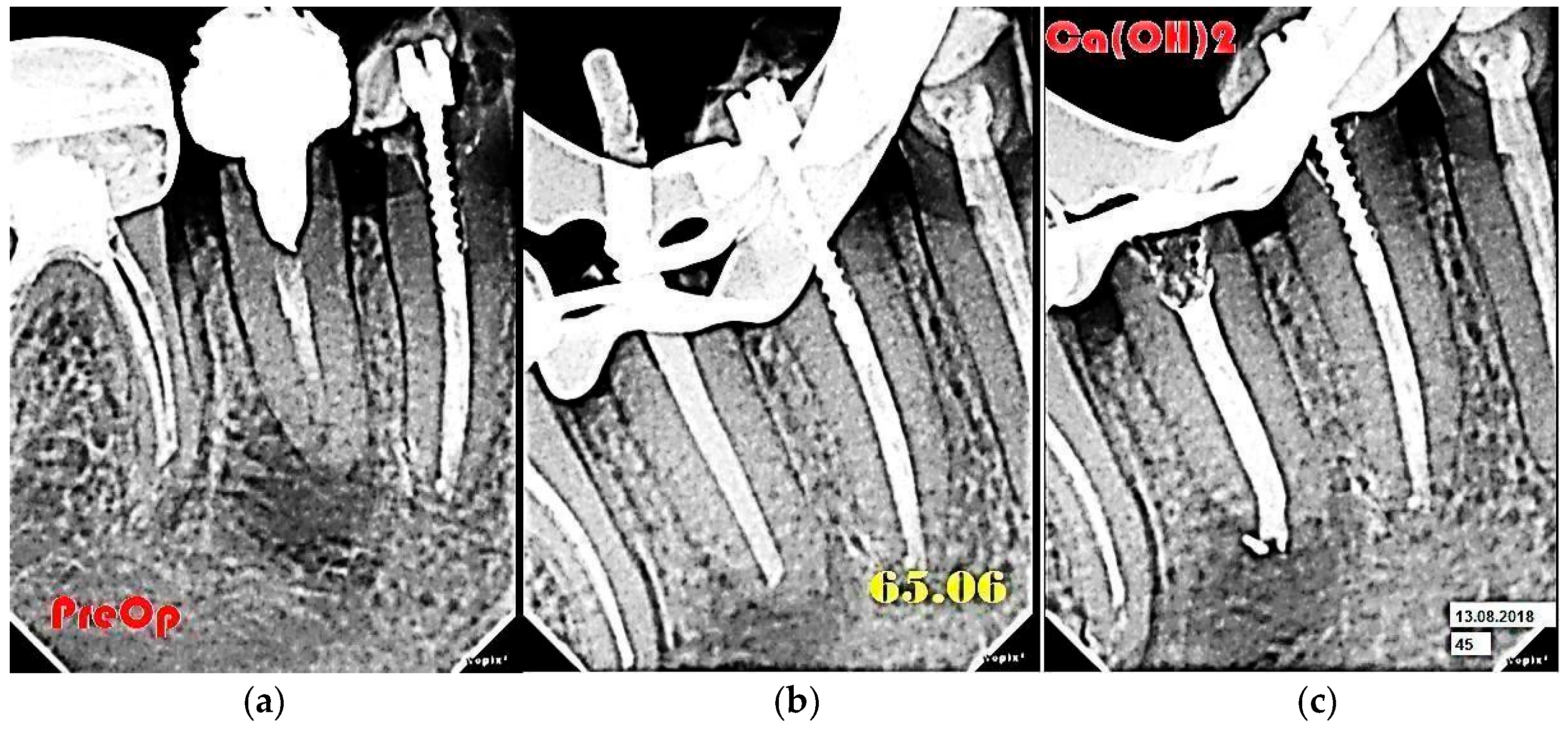Figure 3: Radiographs of tooth 45: (a) initial situation; (b) image with a calibrated gutta-percha pin of 06 taper; (c) Image with a temporary calcium-containing material in the root canal.