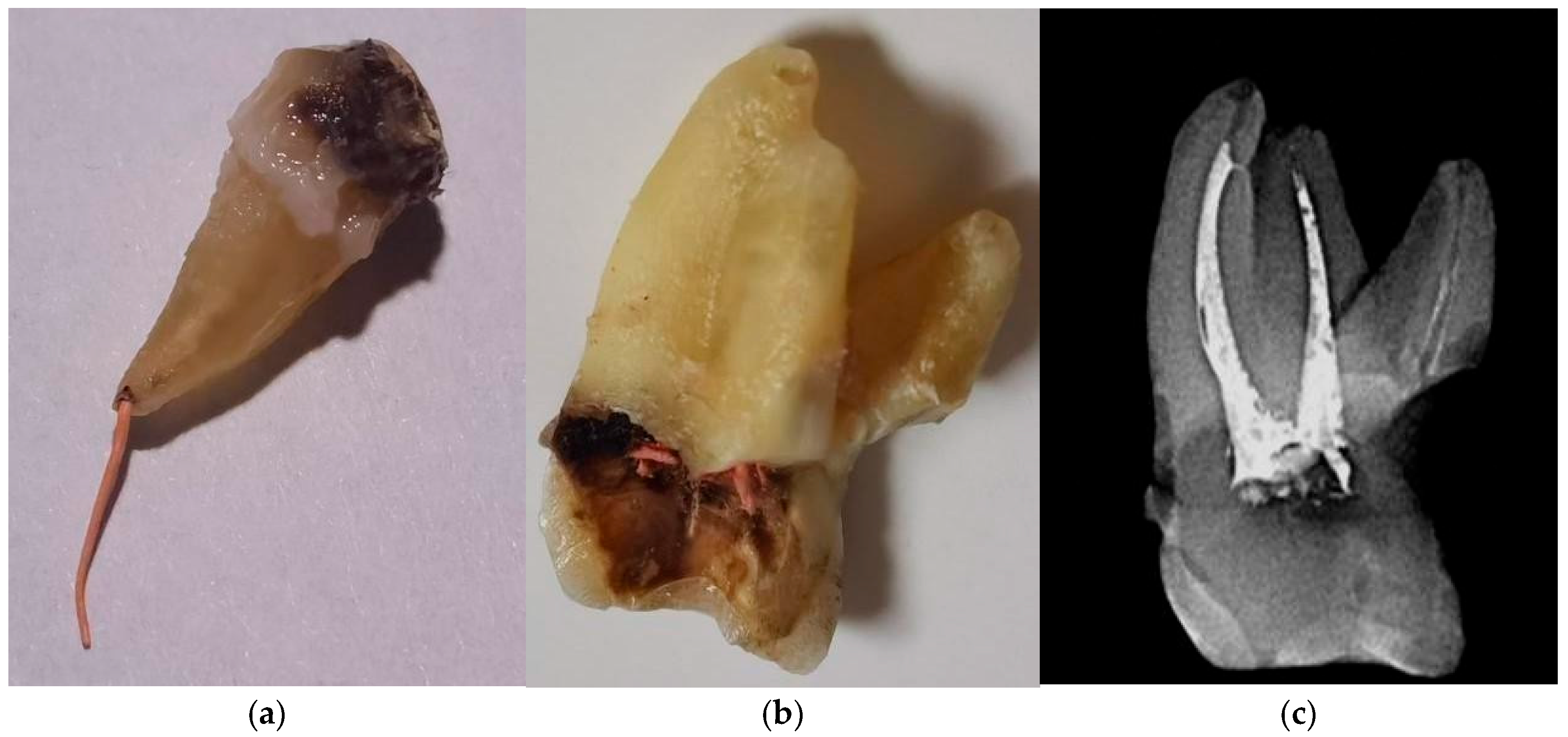 Figure 4: Photo of tooth 35, extracted 2 years after treatment. (a) Gutta-percha pin removed through the destroyed apical constriction. (b) Horizontal and vertical root resorption of tooth 17 2 years after filling. Thinning of the buccal root wall along the entire length, shortening of the roots along the length, and wide apical foramina. (c) Radiograph of tooth 17.