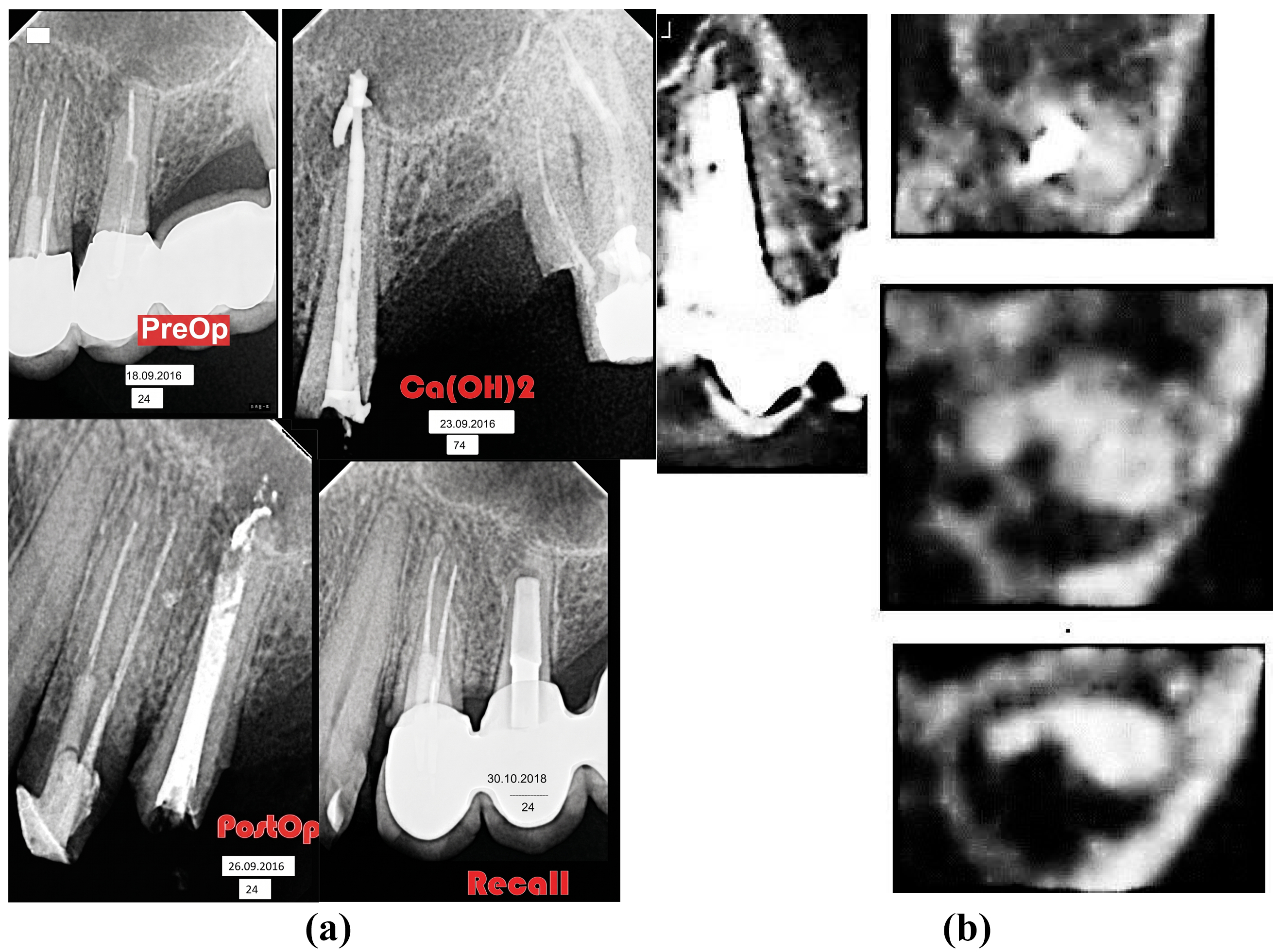 Figure 5: Radiographs of tooth 25: (a) diagnostic, at the time of treatment, and 25 months after completion of treatment; (b) diagnostic CBCT of tooth 25.