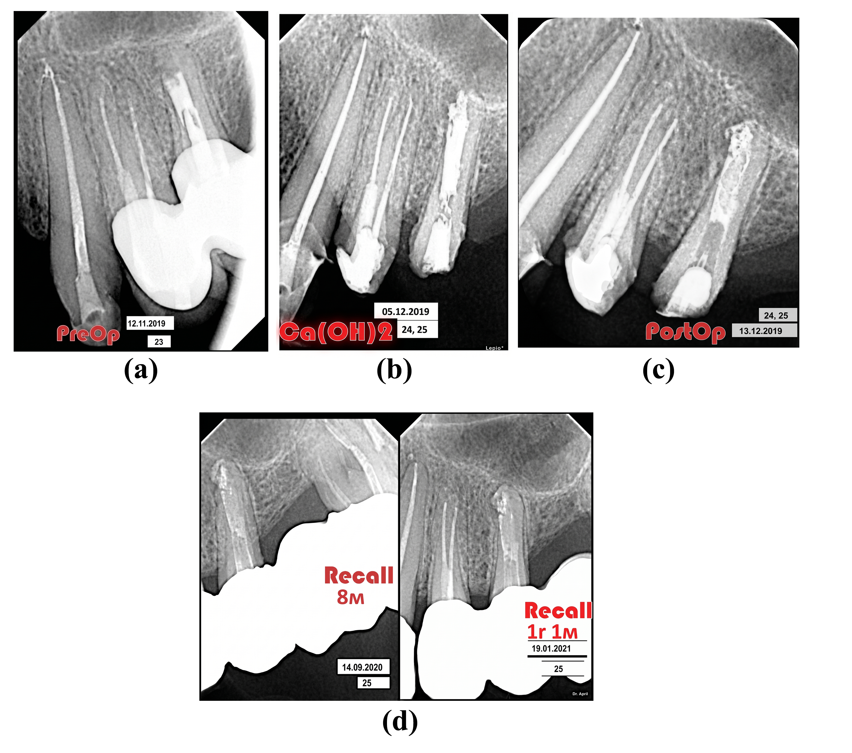 Figure 6: Radiographs of tooth 25. (a) 3 years and 2 months after completion of treatment (b) during retreatment (c) 8 months after completion of treatment (d) 13 months after completion of treatment..