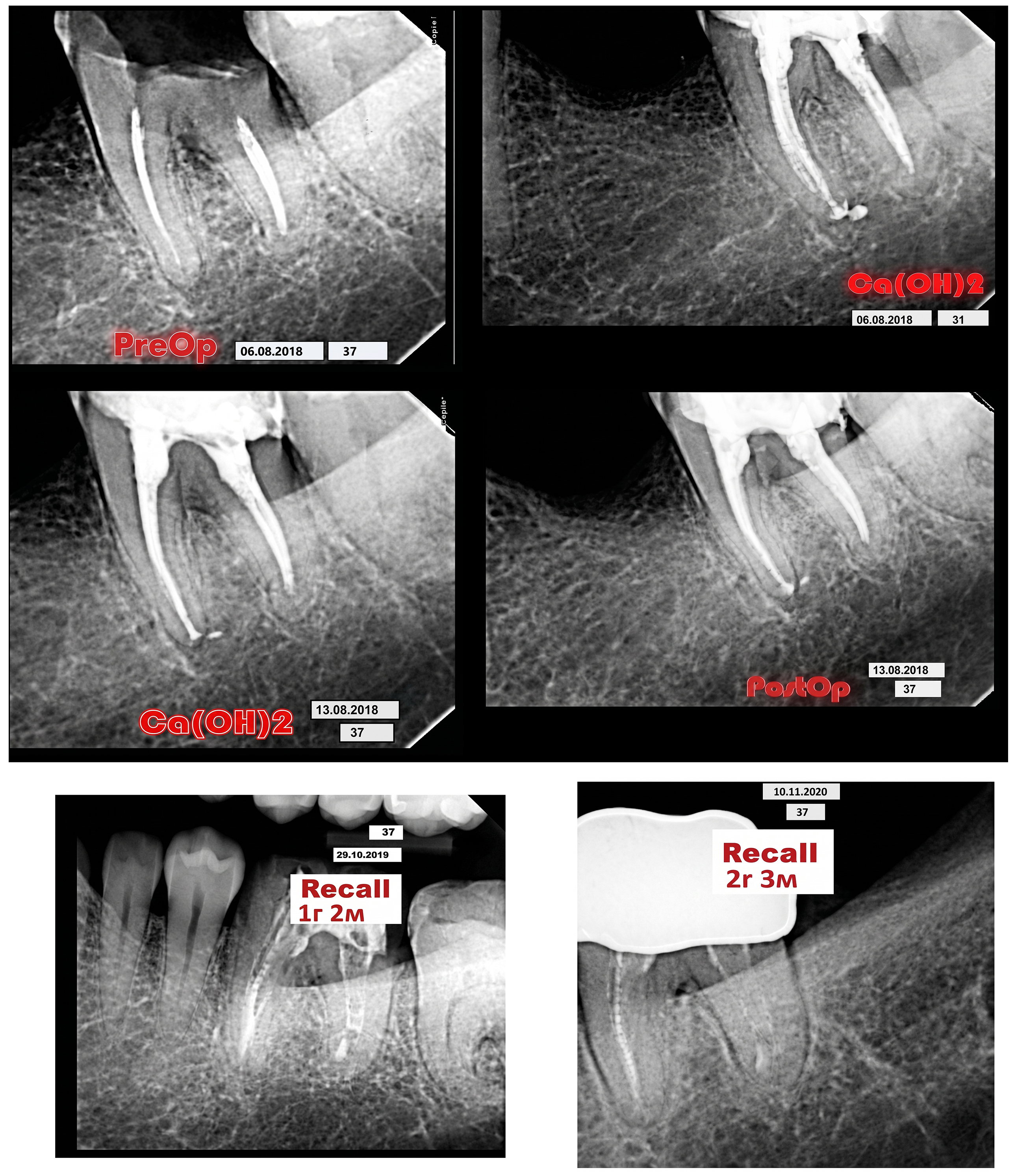 Figure 7: Radiographs of tooth 37: diagnostic; during treatment with a calcium-containing material for temporary root canal obturation; after permanent root canal filling; 14 months after completion of treatment; 2 years and 3 months after completion of treatment.