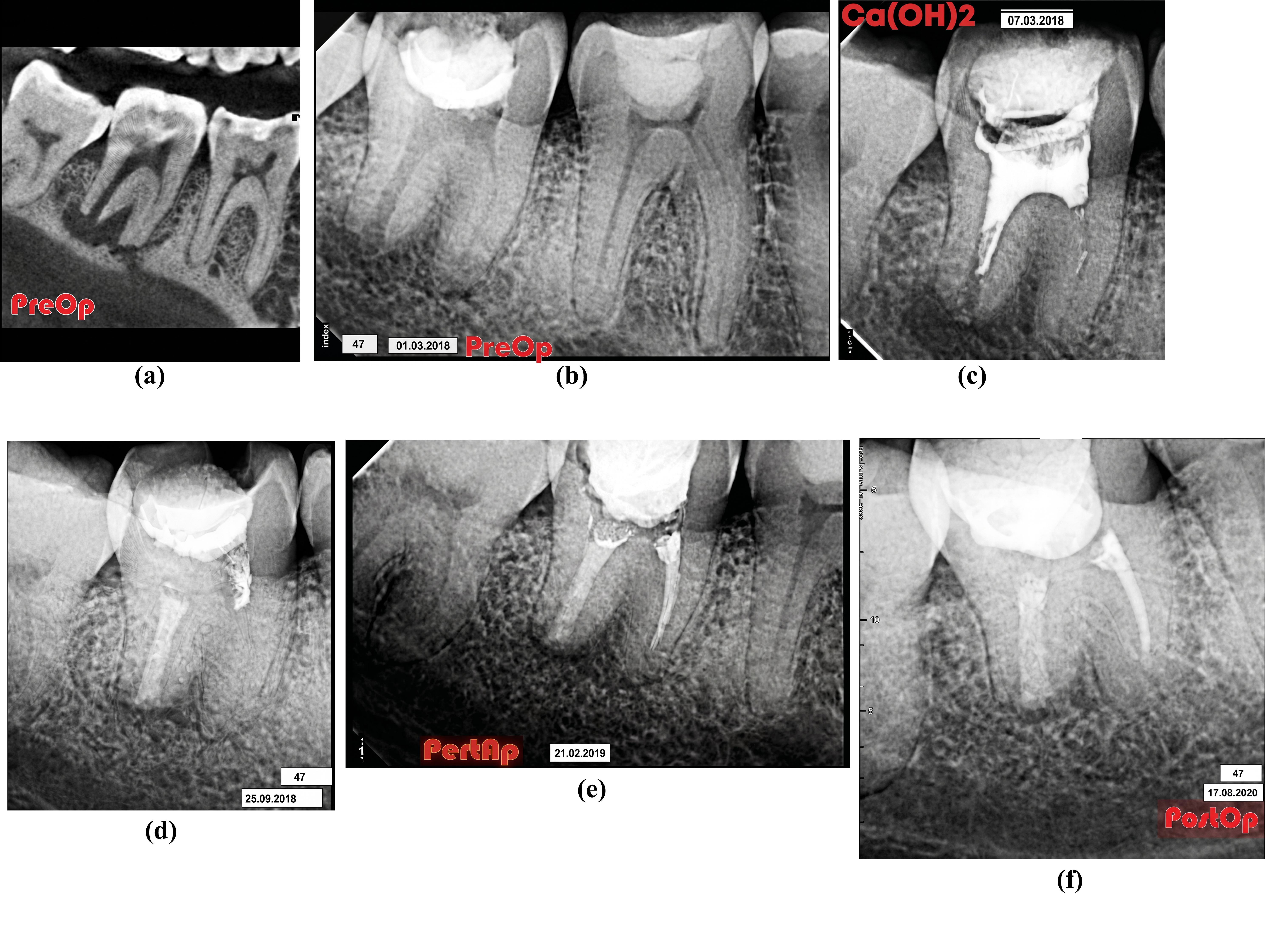 Figure 8: Diagnostic CBCT of tooth 47: (a) Radiographs of tooth 47; (b) diagnostic; (c) during treatment; (d) post-obturation CBCT after root canal filling with Trioxident; (e) 6 months after treatment (f) 1.5 years after treatment.