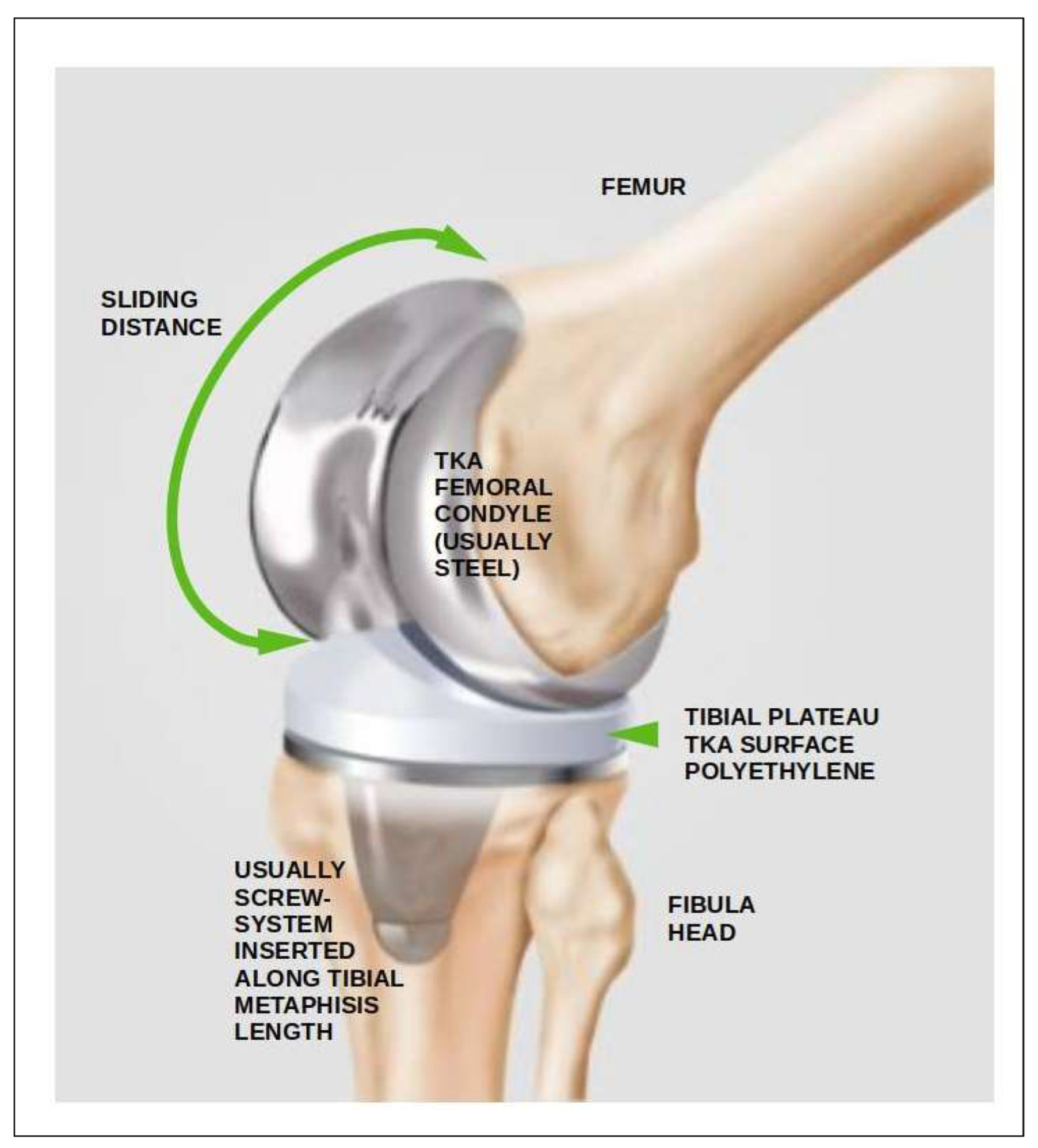 Figure 1: The sketch is completed with the main parts of TKA. Inset, the most important anatomical parts are marked. Note that the femur condyles are made of steel variants, and the tibial plateau is made of polyethylene. [Google free images, Dr. Albrecht, knee and cartilage specialist, website, https://www.knieschmerzen-wien.at/albrechtchristian-en.html (accessed on 1 January 2017)], modified and drawn by Francisco Casesnoves.