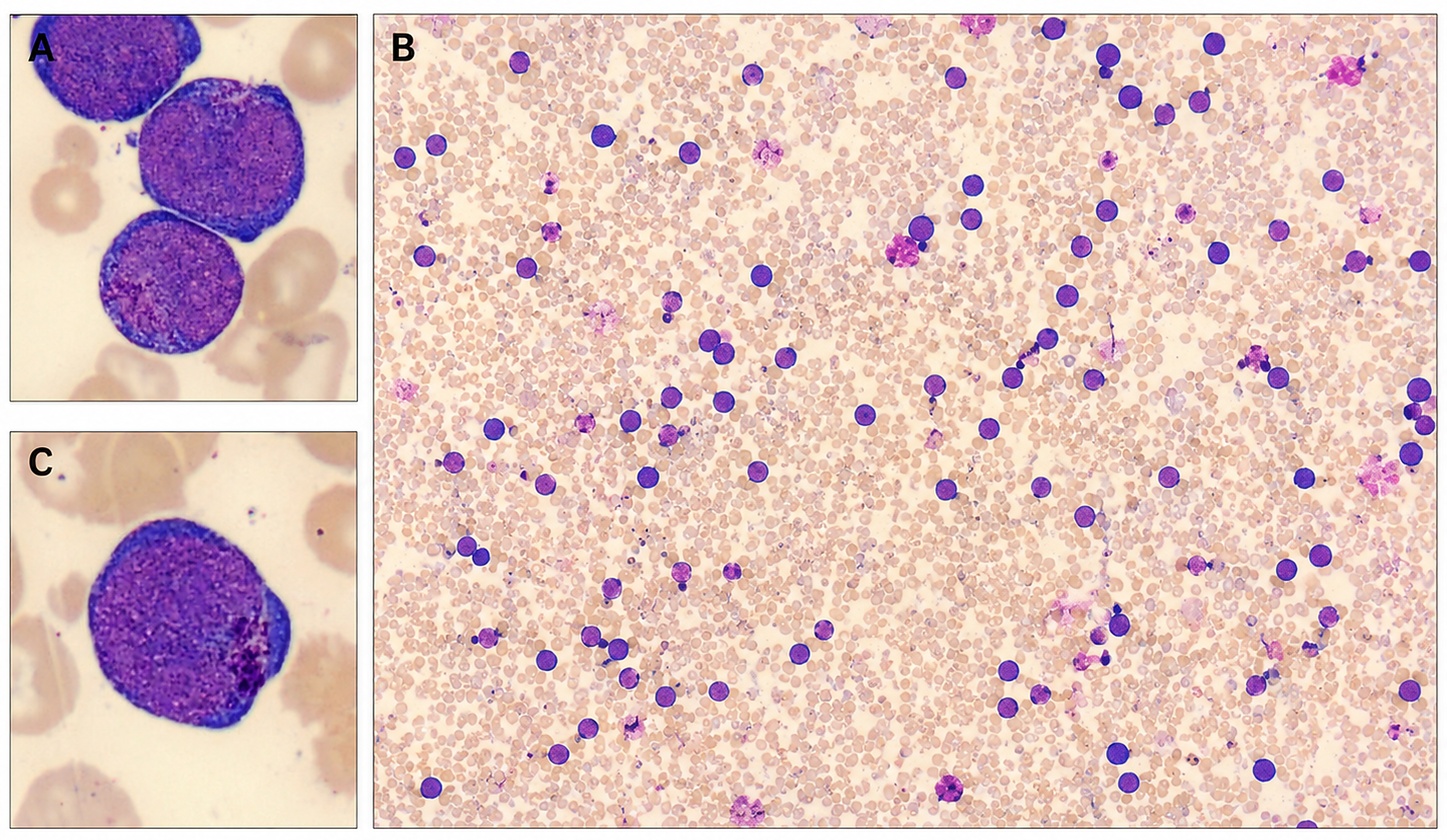 Figure 2: Representative bone marrow aspirate morphology in pediatric pure erythroid leukemia. (A,C) High-power digital crops show large immature erythroid cells/proerythroblasts with round to slightly irregular nuclei, fine chromatin, prominent nucleoli, deeply basophilic cytoplasm, and cytoplasmic vacuolization. (B) Lower-power overview shows numerous dispersed erythroblasts and marked erythroid predominance. The panels comprise anonymized, previously unpublished, patient-derived bone marrow aspirate smear images obtained during routine clinical care and supplied by the authors; they were cropped only for panel assembly. The smears were processed and stained using the Sysmex SP-50 Slidemaker Stainer. Panel (B) was examined using a 10× objective, and the digital image was acquired using the CellaVision DC-1 system. Panels (A, C) were examined using an oil-immersion objective and imaged using the same CellaVision DC-1 system. The exact objective magnification for Panels (A, C), the specific staining reagent/protocol, and the pixel-to-micrometer calibration could not be independently verified from the available original records. Therefore, no scale bar is provided. Morphologic findings should be interpreted together with the immunophenotypic and molecular findings. Written informed consent for publication of these anonymized images was obtained from the patient’s parent/legal guardian; further ethical details are provided in the Ethical Approval and Consent for Publication sections.