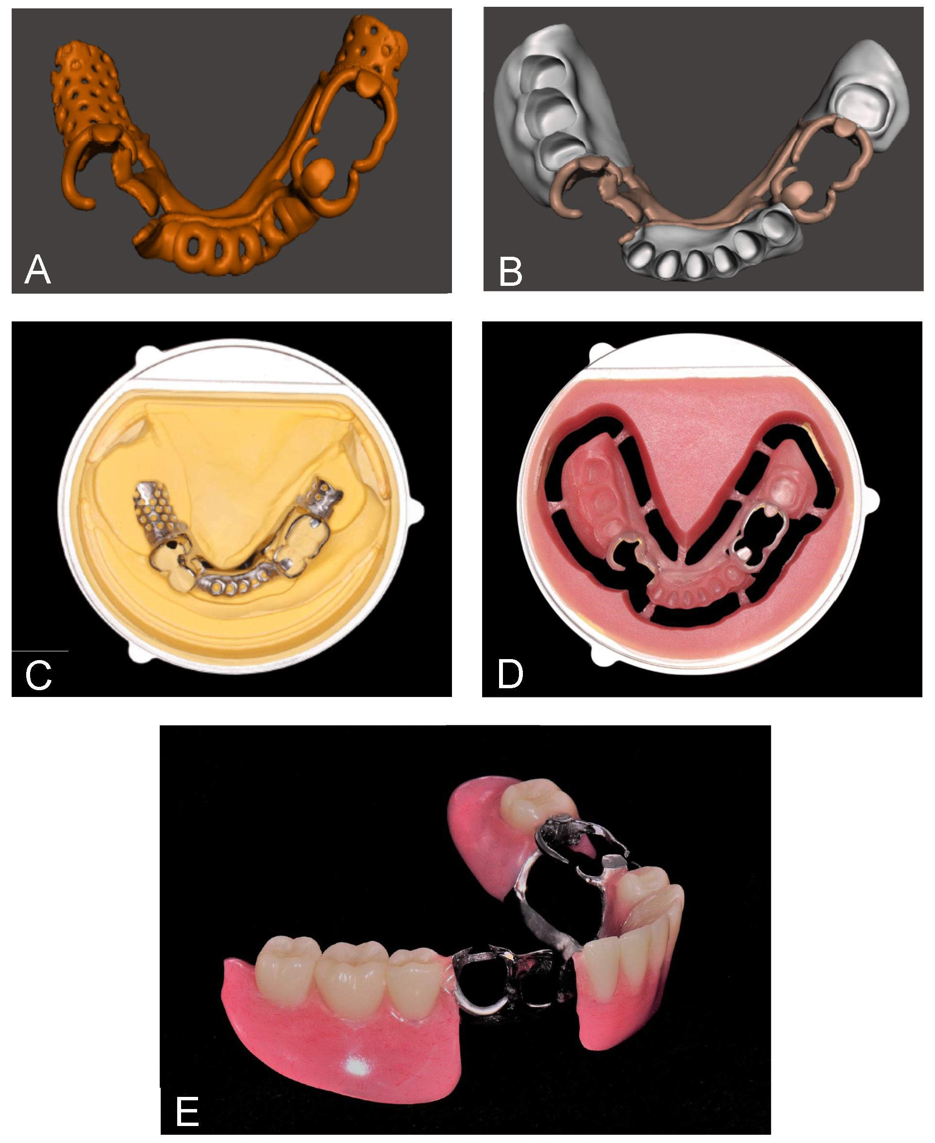 Figure 10: <p>RPD fabricated by digital workflow with milling technology, A and B CAD virtual designing, (<strong>A</strong>) Offsetting metal framework, (<strong>B</strong>) Combining the offset metal framework and denture base, (<strong>C</strong>) Metal framework seated on stone cast, (<strong>D</strong>) Milled denture base and offset metal structure complex, (<strong>E</strong>) Completed removable partial denture [<a href="#ref167">167</a>].</p>
