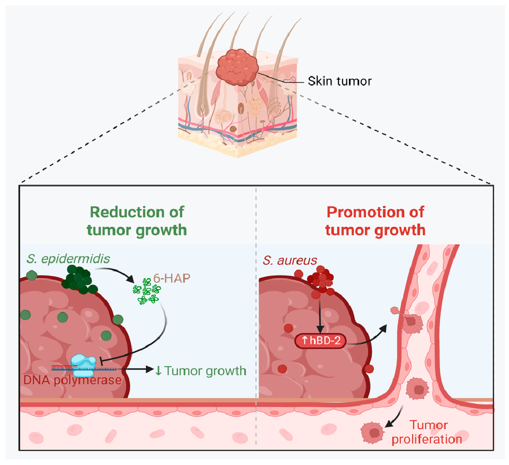 Figure 7: <p><strong>The Dual Role of <em>Staphylococcus</em> Bacteria in Skin Cancer.</strong>&nbsp;<em>S. epidermidis</em> produces 6-N-hydroxyaminopurine (6-HAP), a substance that inhibits skin tumor proliferation by interfering with DNA polymerase activity, thereby slowing the growth of cancer cells while remaining safe for normal skin cells. In contrast, the presence of <em>S. aureus</em> in the skin tumor microenvironment promotes tumor proliferation by stimulating host cells to overproduce human &beta;-defensin-2 (hBD-2).</p>
