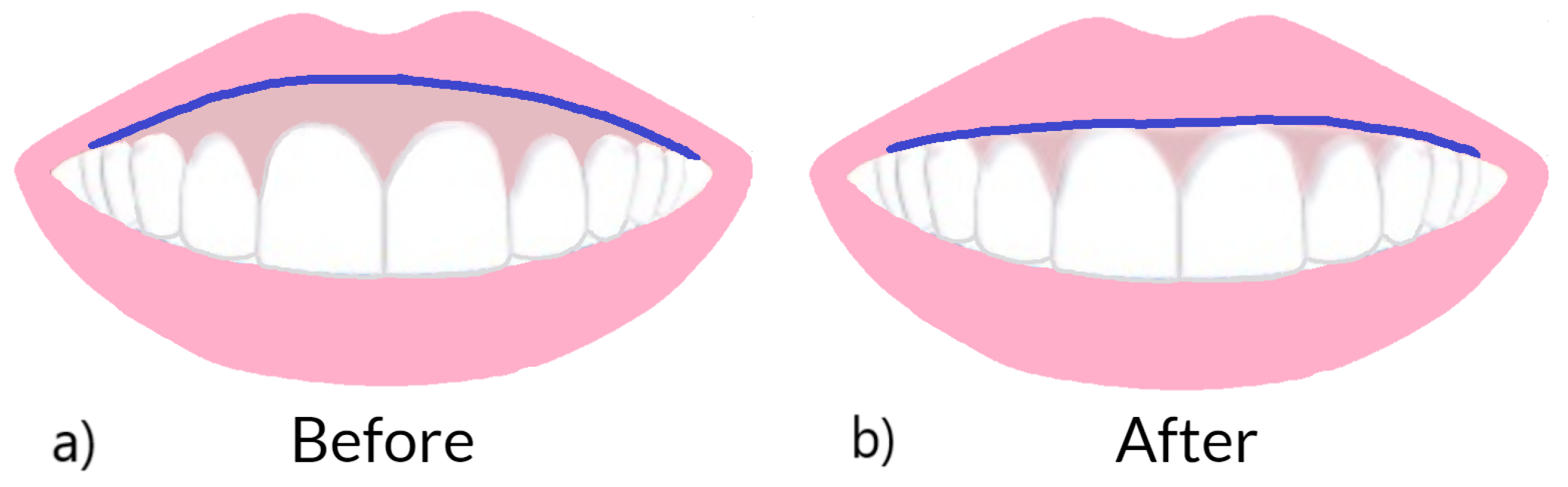 Figure 1: Presence of excessive gingival display in (a) before orthodontic treatment. An ideal lip line after treatment shown in (b). The blue line shows the location of the lip line.
