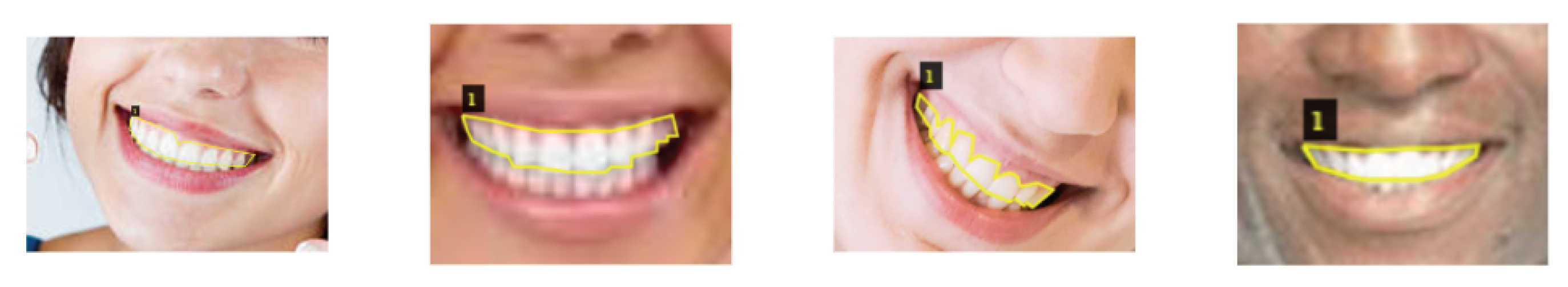 Figure 2: A sample of images with labeled maxillary teeth required to create an attribute-value pair JSON file of pixels to labels for instance segmentation using an annotation tool called VGG Image Annotator.
