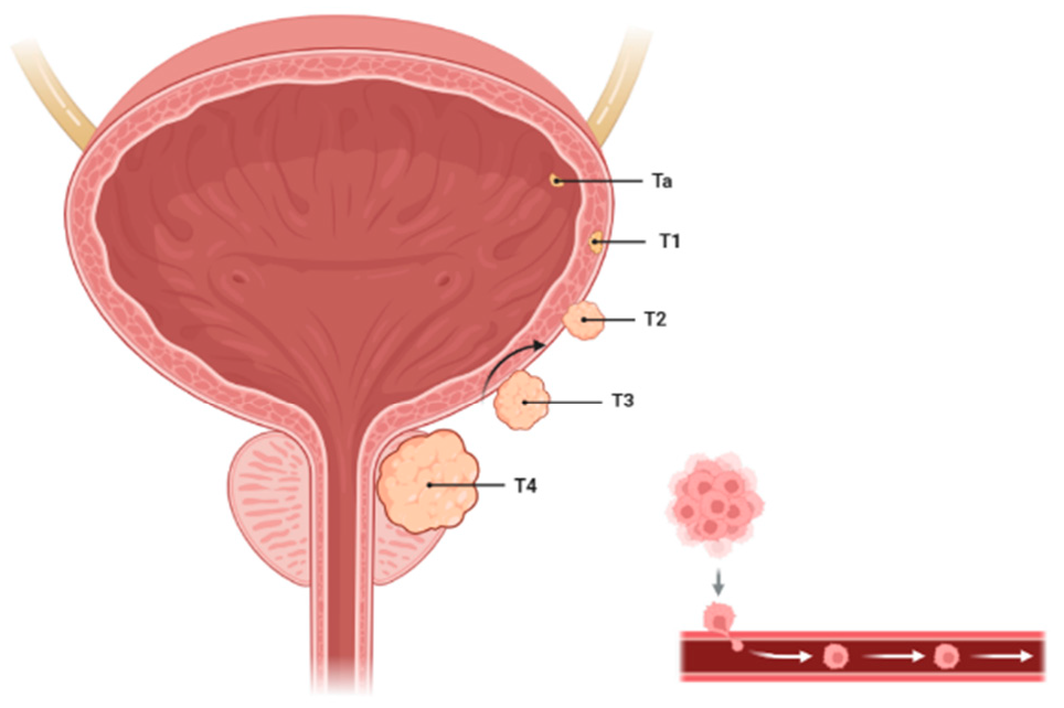 Figure 1: <p>illustrates bladder cancer staging using the TNM classification, where the &ldquo;T&rdquo; component refers to the extent of tumor invasion. Ta indicates a non-invasive papillary tumor confined to the bladder lining, while Tis (carcinoma in situ) refers to a flat, high-grade, non-invasive lesion. T1 tumors invade the connective tissue beneath the lining (lamina propria) but not the muscle. T2 tumors penetrate the muscle layer. T2a involves the inner half, and T2b the outer half. T3 tumors extend into the peri-vesical (fatty) tissue surrounding the bladder, with T3a indicating microscopic and T3b macroscopic invasion. T4 tumors have spread to nearby organs such as the prostate, uterus, or pelvic wall. This staging helps determine the severity of the disease and guides treatment planning. Created with <a href="https://app.biorender.com/illustrations/683913466895553df7df7bc5" target="_blank" rel="noopener noreferrer">https://app.biorender.com/illustrations/683913466895553df7df7bc5</a> (accessed on 10 January 2025).</p>

